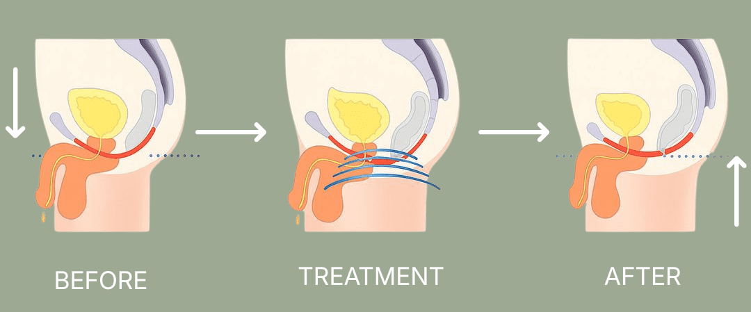 Pelvic Floor Chair therapy strengthening pelvic muscles for improved bladder control and support