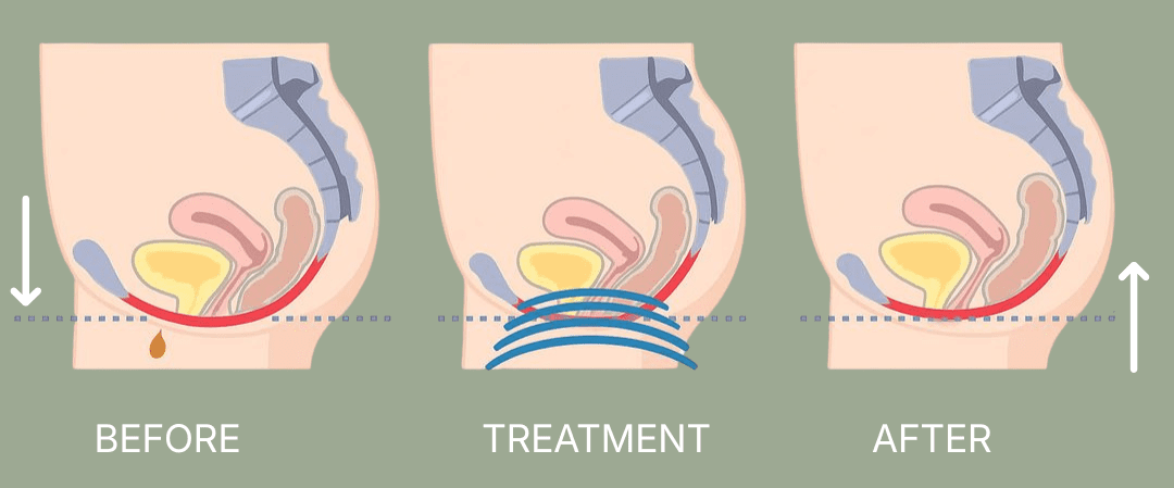 BWell Clinic pelvic floor chair strengthening weak pelvic muscles with thousands of contractions for improved bladder control and pelvic support